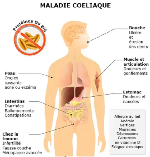 Schéma des symptômes de la maladie cœliaque.